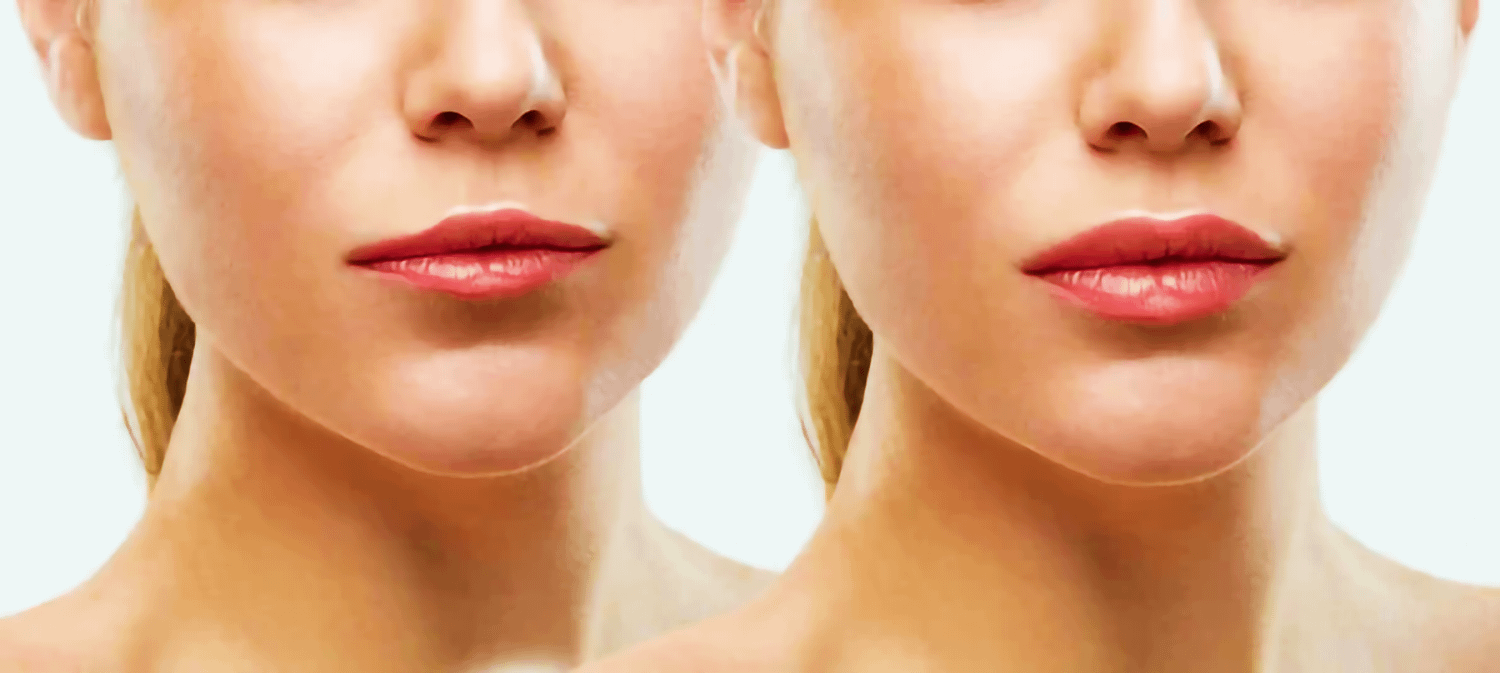 Prima e dopo trattamento filler labbra per aumento del volume