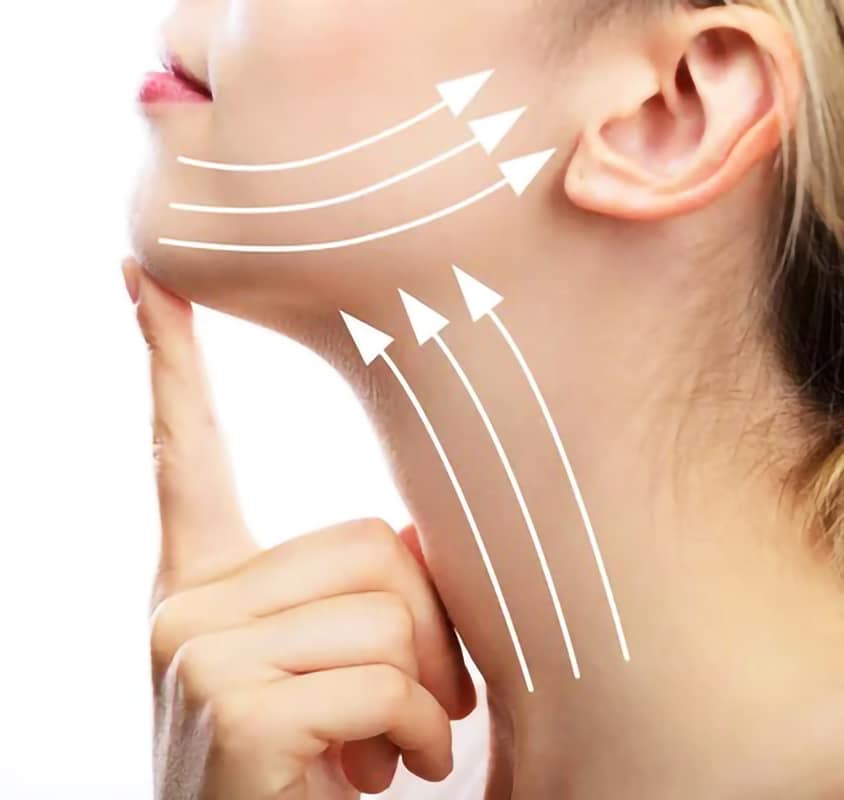 Primo piano del collo con frecce indicanti l'effetto del lifting ottenuto con la tossina botulinica.